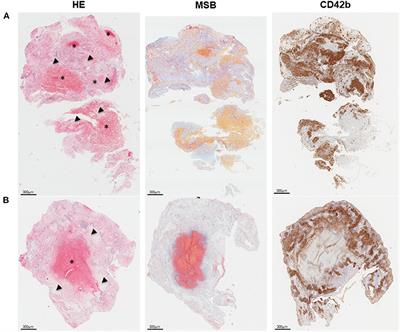 Inside the Thrombus: Association of Hemostatic Parameters With Outcomes in Large Vessel Stroke Patients